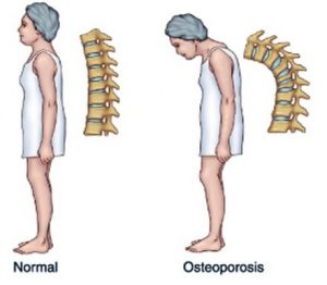 Osteoporosis in Kenya