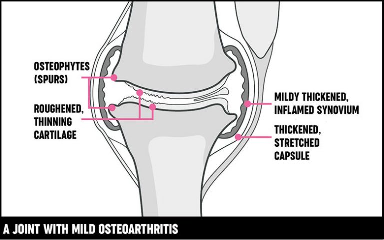 Osteoarthritis -best collagen supplements for your painful joints, in Kenya