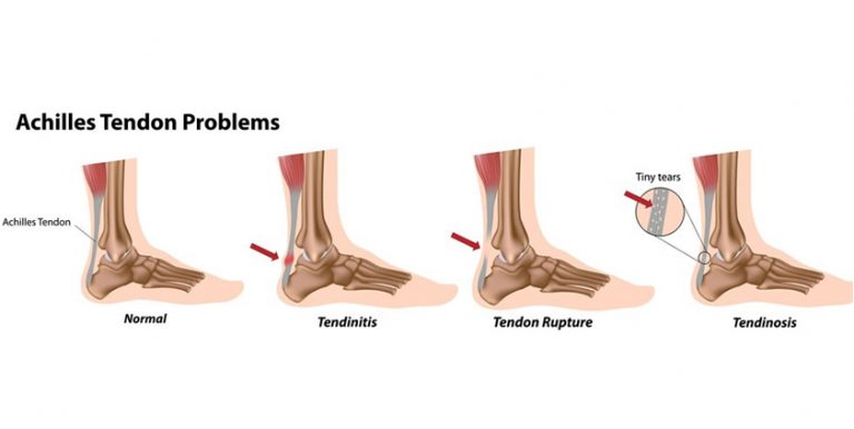 Tendinopathy: Tendinosis