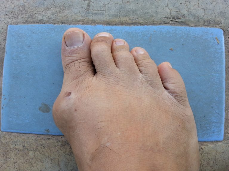 Gout- 5 things you need to know about gout today