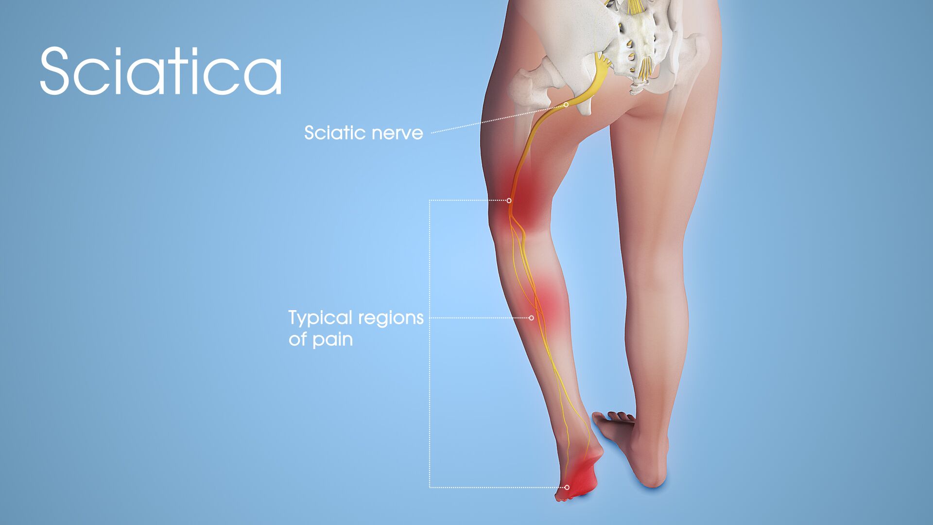 TREATMENT FOR SCIATIC NERVE PAIN | HOW SUPPLEMENTS WORK